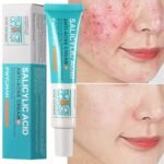 Salicylic Acid Acne Removal Cream - Image 4