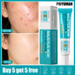 Salicylic Acid Acne Removal Cream - Image 6