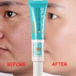 Salicylic Acid Acne Removal Cream - Image 3